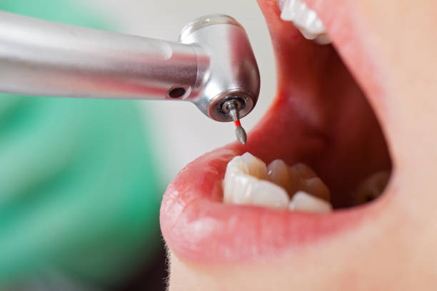 Best Emergency Tooth Extraction in Pascoag, RI